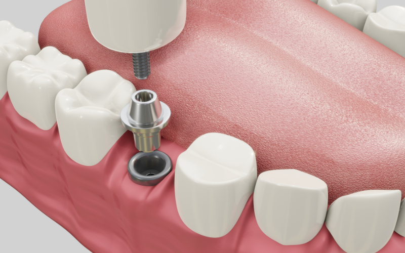 A Key Component in Dental Implants
