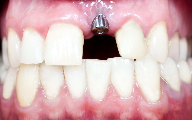 Dental Implants Understanding the Basics