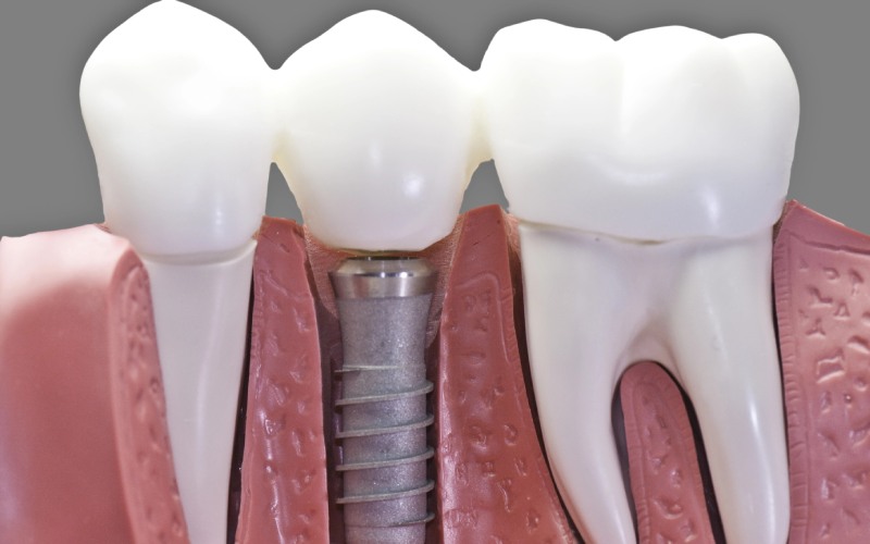 Close-up of a dental implant between two teeth models.