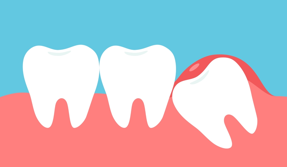 impacted wisdom teeth treatment